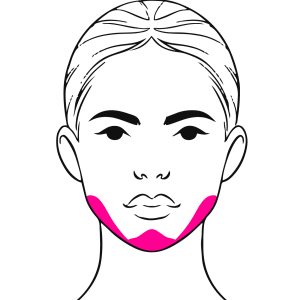 Chin and Jaw Filler Model Treatment